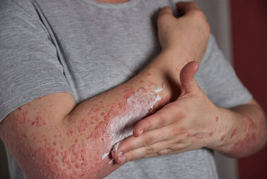 Psoriasis : Types, symptômes et meilleurs traitements disponibles